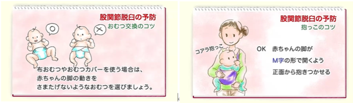 股関節脱臼（日本小児整形外科学会）